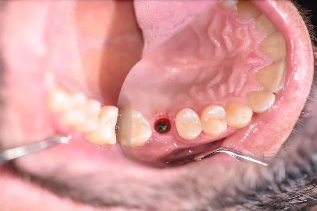 upper back tooth: before final crown