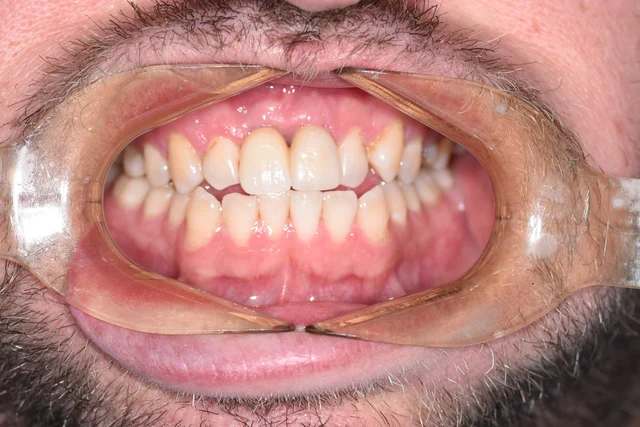 upper front tooth: after crown fitting